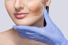 Acne-Treatment-in-Jeddah