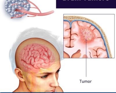 Brain-Tumor-Surgery