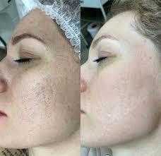 Carbon-Laser-Before-and-After