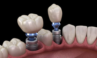 Implant-Restoration-400×241-1