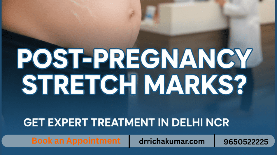 Post-Pregnancy Stretch Marks? Get Expert Treatment in Delhi NCR