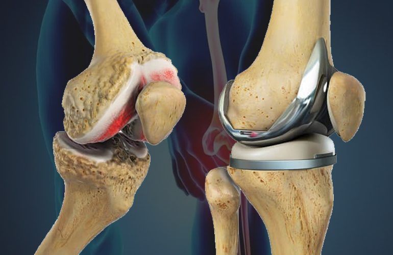 Knee Replacement Surgeon in Vaishali Nagar Jaipur – Dr. Arvind Asopa
