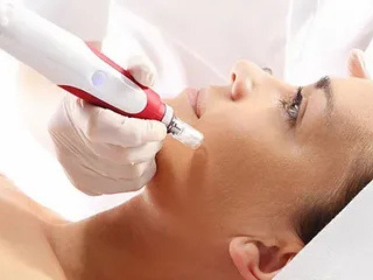 Micro Needling Near Me | Advanced Skin Care in California