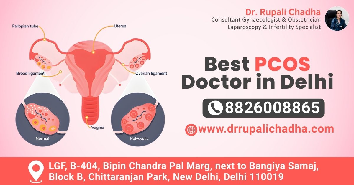 Best PCOS Doctor in Delhi for Fertility Care: Dr. Rupali Chadha