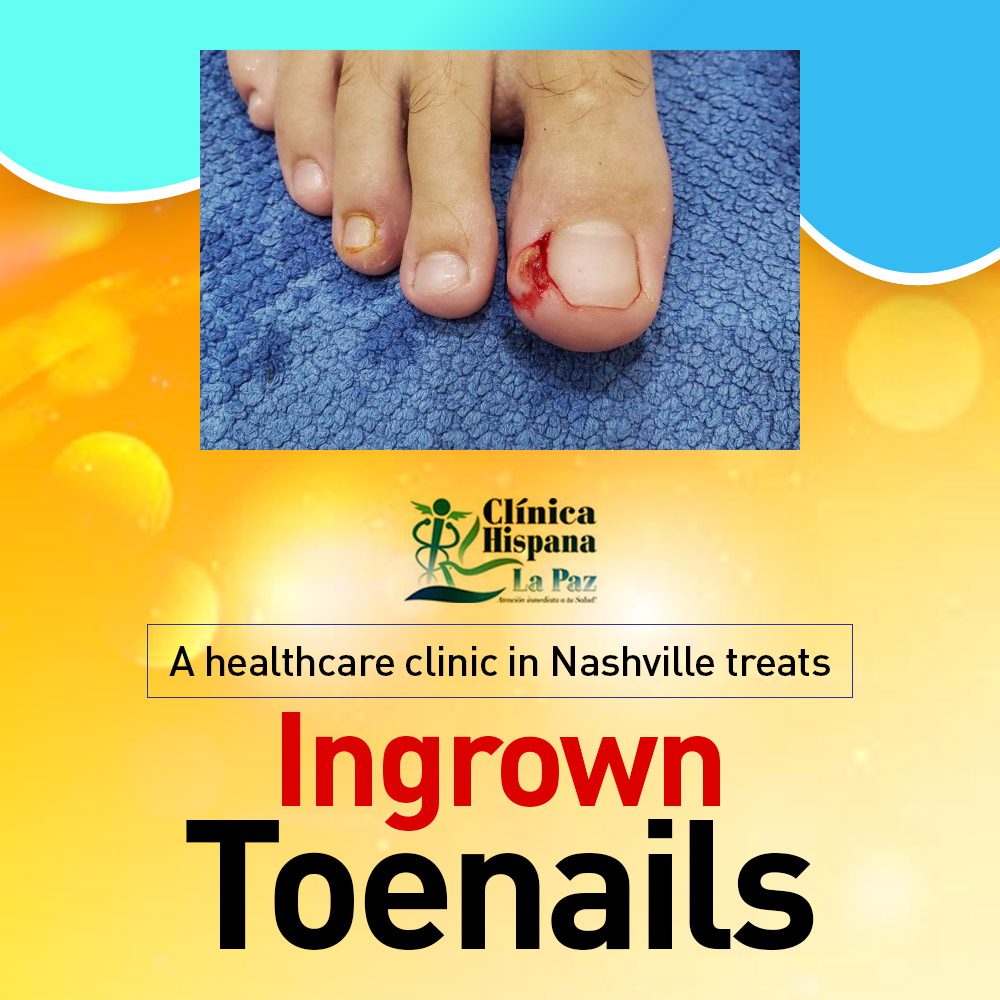 A healthcare clinic in Nashvilletreats ingrown toenails