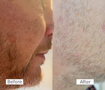 before-after15-r1j26oqh1dthkt7lvck0cu8nw3lbac60xg0l2hr5tk