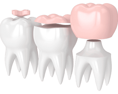 Dental-Crown-1