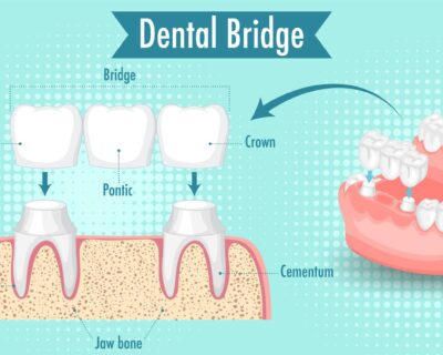infographic-human-dental-bridge_1308-91618