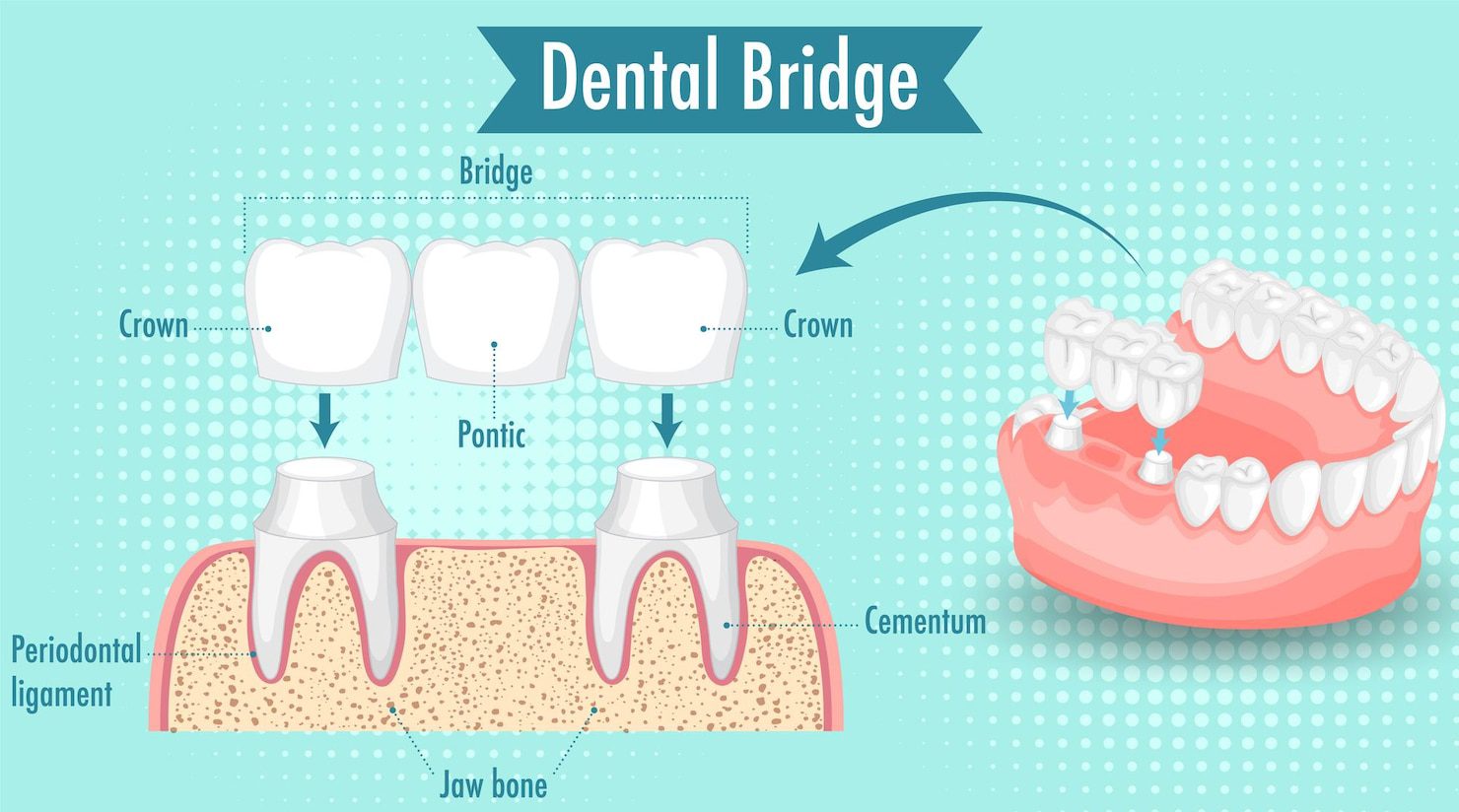 Dental Bridges Arizona – Restore Missing Teeth for Just $699 Per Unit