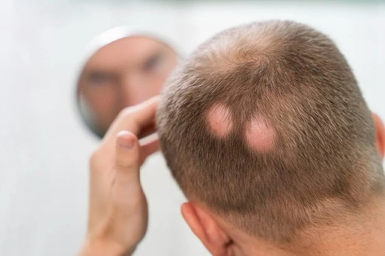 Expert Alopecia Care | Alopecia Treatment Center Lawrenceville GA