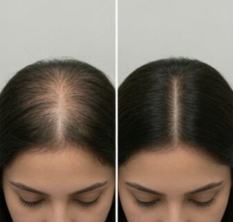 Hair-PRP-Treatment-Faridabad