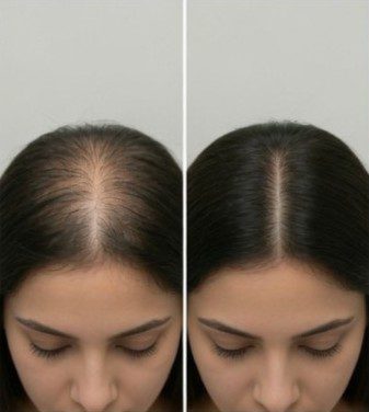Hair Thinning PRP Faridabad